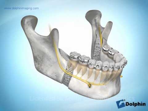 Mandibular Advancement Surgery