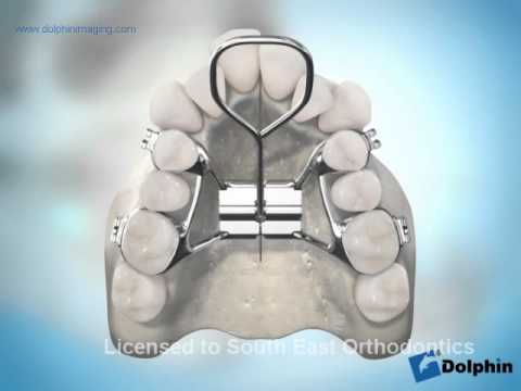 Surgically Assisted Palatal Expansion