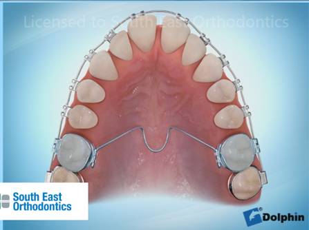 Kid's Braces Melbourne | Early Orthodontics Berwick