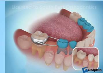 orthodontic space maintainer